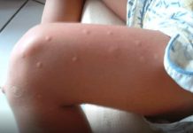KOMARCI VAM PRAVE PAKAO OD ŽIVOTA? Samo isijecite OVO VOĆE na pola i ostavite u sobi, VIŠE IH NIKADA NEĆETE VIDJETI BLIZU! KOMARCI VAM PRAVE PAKAO OD ŽIVOTA? Samo isijecite OVO VOĆE na pola i ostavite u sobi, VIŠE IH NIKADA NEĆETE VIDJETI BLIZU! - featured image