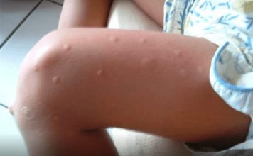 KOMARCI VAM PRAVE PAKAO OD ŽIVOTA? Samo isijecite OVO VOĆE na pola i ostavite u sobi, VIŠE IH NIKADA NEĆETE VIDJETI BLIZU! KOMARCI VAM PRAVE PAKAO OD ŽIVOTA? Samo isijecite OVO VOĆE na pola i ostavite u sobi, VIŠE IH NIKADA NEĆETE VIDJETI BLIZU! - featured image